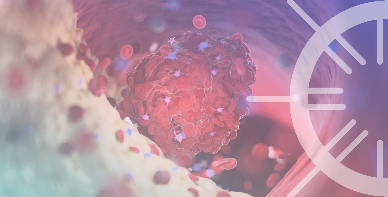 Оптимизация антитромботической терапии у пациента после стентирования коронарных артерий с впервые диагностированной фибрилляцией предсердий